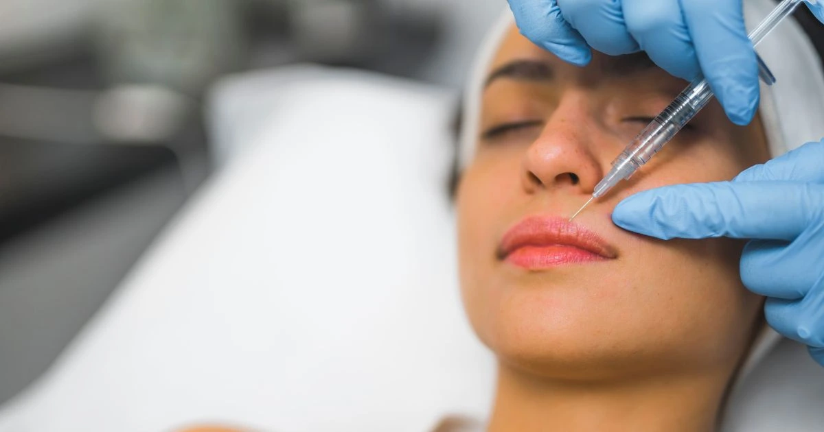 Dermal filler being applied to the perioral area to soften smile lines and marionette lines.