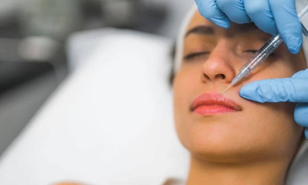 Dermal filler being applied to the perioral area to soften smile lines and marionette lines.